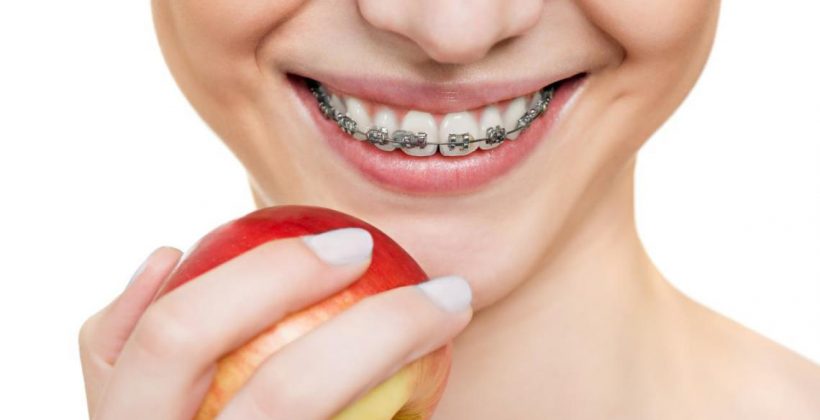 3 maneras de mantener la higiene dental con ortodoncia
