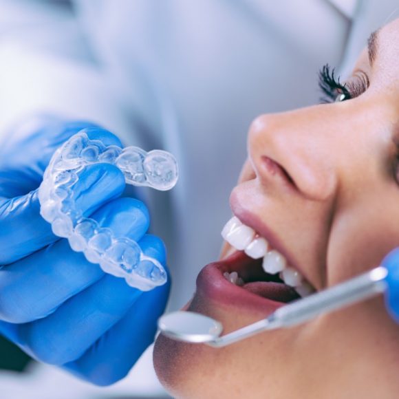 Lo que debe saber sobre el blanqueamiento dental